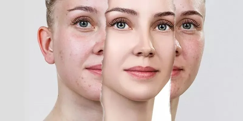 Acne Scars Removal-Mediterranean Beauty